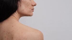 woman with body acne on back and face