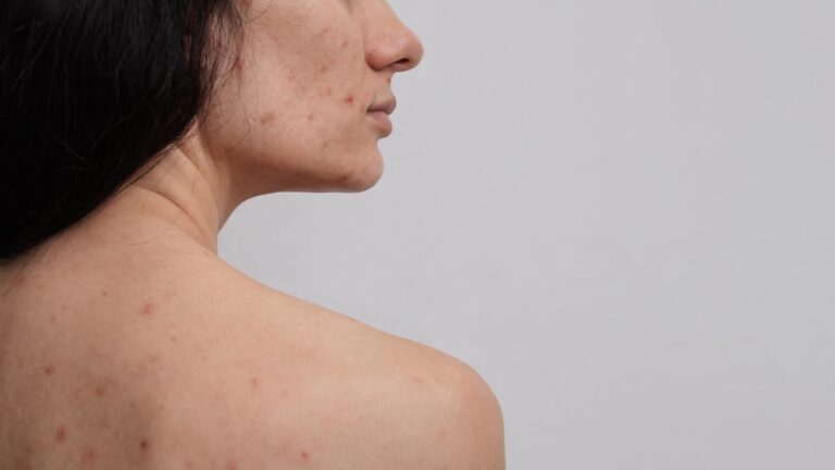woman with body acne on back and face